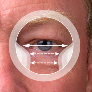 MULTIFOCAL PROGRESIVO INTERMEDIO